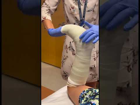 How to apply a short leg cast | Boston Children’s Hospital [Video]