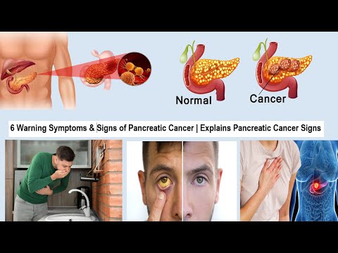 6 Warning Symptoms & Signs of Pancreatic Cancer | Explains Pancreatic Cancer Signs [Video]