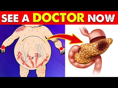 10 warning signs and symptoms of pancreatic cancer you shouldn’t ignore [Video]