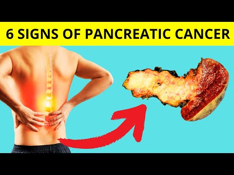 6 Warning Signs of Pancreatic Cancer [Video]