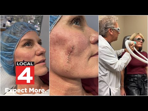 Karen Drew reflects on healing process 6 months since skin cancer surgery [Video]