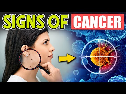 10 Early Warning Signs of CANCER Most People Dismiss Too Easily [Video]