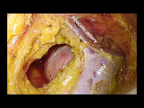 Retrocecal, Supracolic, and Medial Dissection (RESUME approach) for Right-sided Colon Cancer [Video]