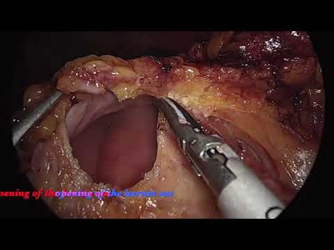 Incidental Diagnosis and Intraoperative Treatment of Left Paraduodenal Hernia [Video]
