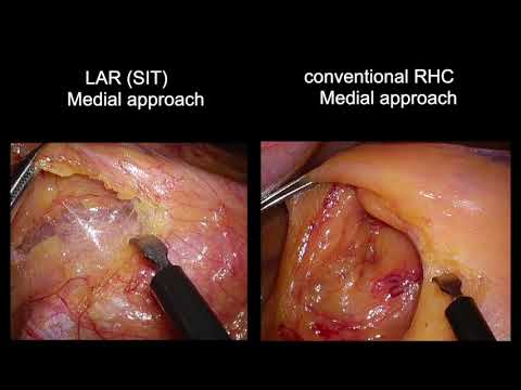 Laparoscopic low anterior resection for rectal cancer with situs inversus totalis [Video]