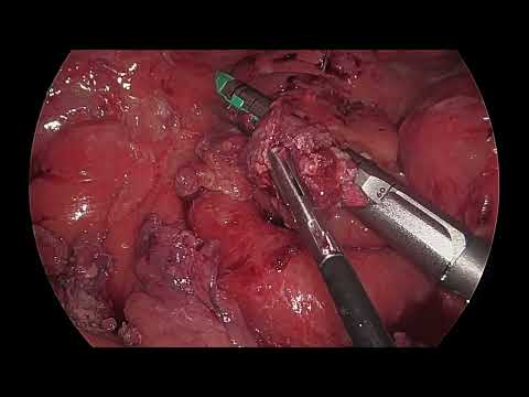 Diagnosis and Management of Tip of J Pouch Leaks [Video]
