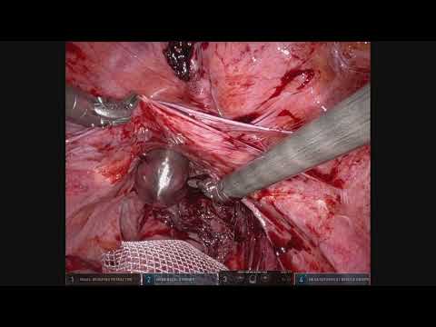 Robotic ventral mesh rectopexy: troubleshooting in redo surgery [Video]