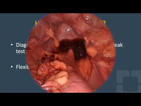 Endoscopic Repair of Ileorectal Anastomotic Sinus [Video]