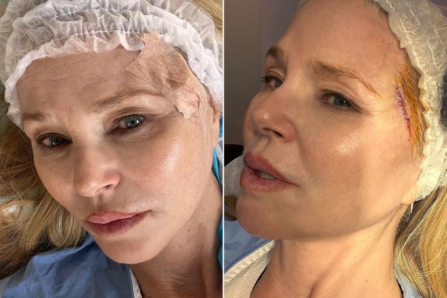 Christie Brinkley Reveals She Had Skin Cancer Removed from Face [Video]