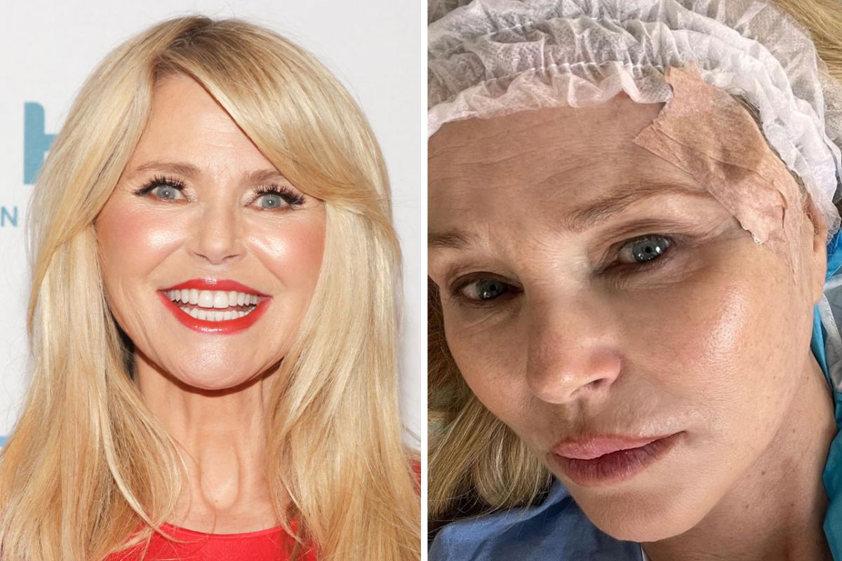 National Lampoons Vacation Star Christie Brinkley Underwent Procedure To Remove Skin Cancer: Stitched Me Up To Perfection [Video]