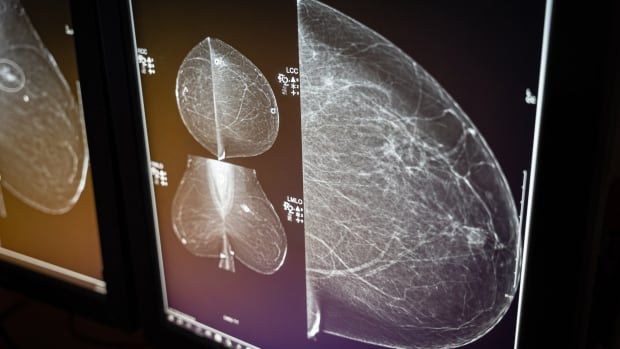 B.C. patients worry as breast cancer screening wait times climb [Video]
