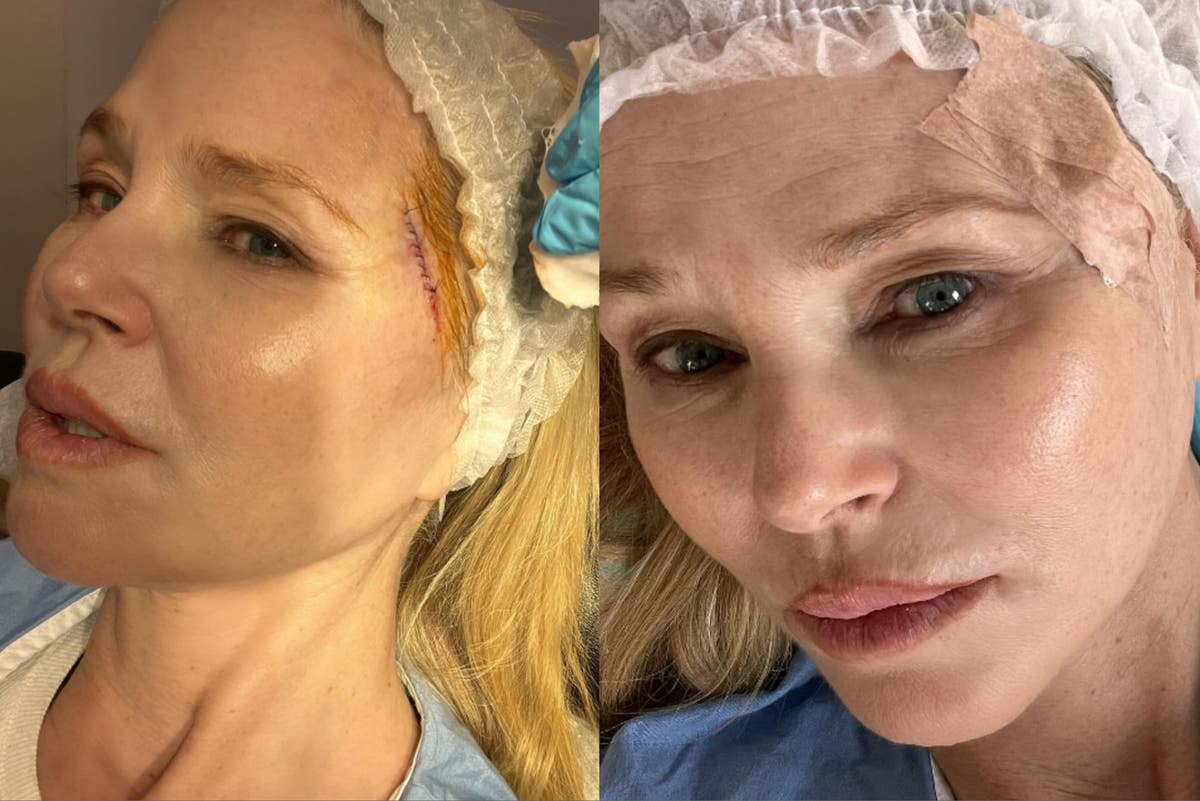 Christie Brinkley undergoes skin cancer surgery after revealing diagnosis [Video]