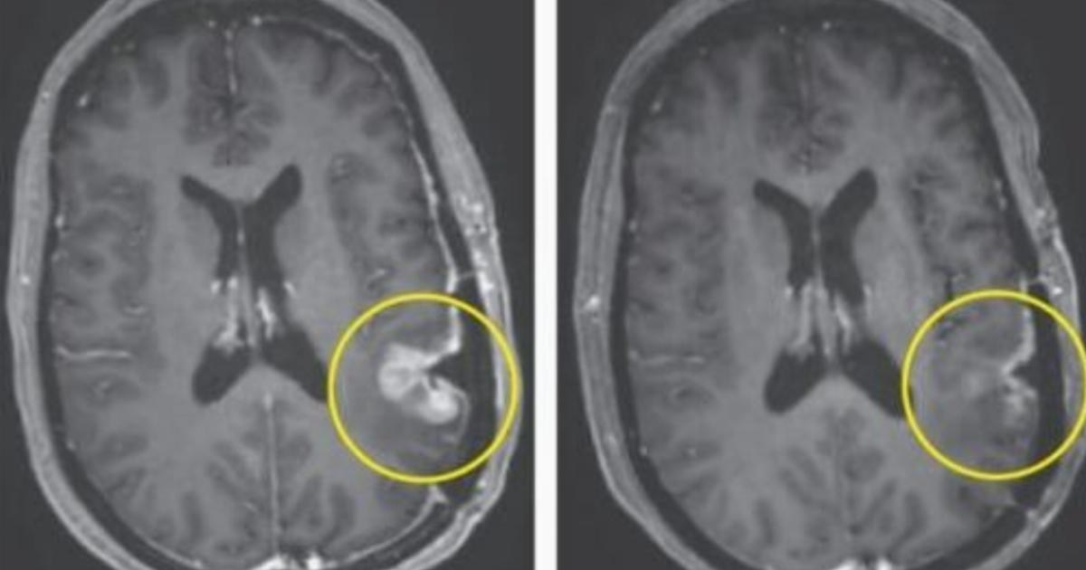 New cancer breakthrough sees brain tumour almost disappear in 5 days | Tech News [Video]
