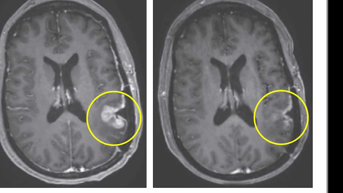 Clinical trial shows ‘dramatic and rapid’ progress against brain cancer [Video]