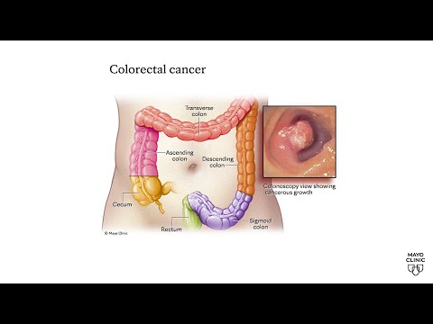 Mayo Clinic Minute: Warning signs of colorectal cancer in younger adults [Video]