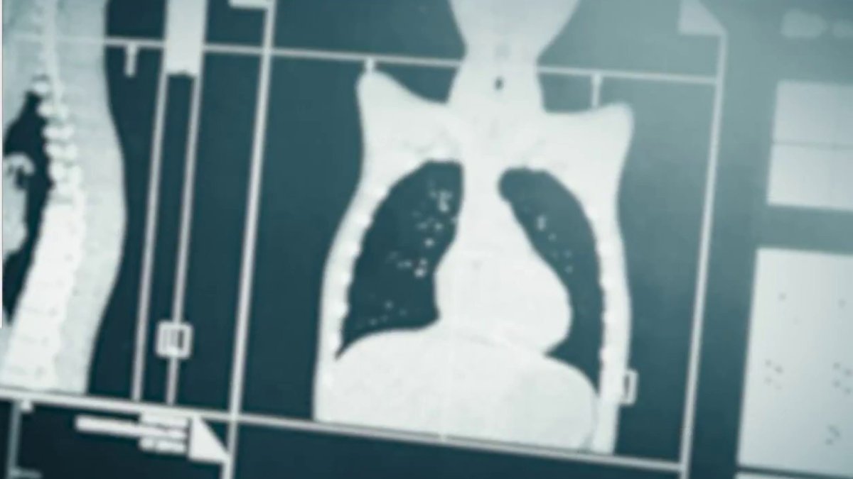 Prevalence of lung cancer in Asian American women  NBC Bay Area [Video]