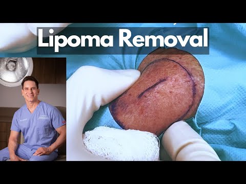 How a Board Certified Dermatologist Removes a Lipoma | CONTOUR DERMATOLOGY [Video]