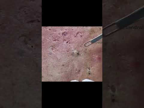 Blackheads for Days [Video]