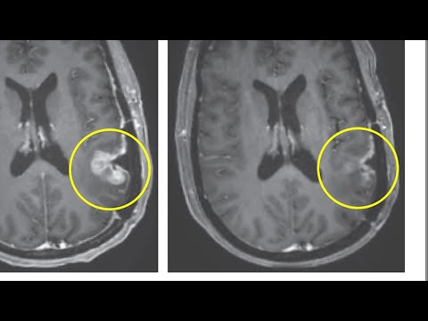Early clinical trial results show dramatic progress against glioblastoma tumors [Video]