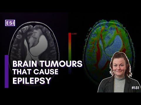 Epilepsy Caused by Brain Tumours – Kate Connor [Video]