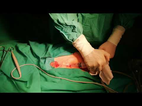 Endoscopic pilonidal sinus treatment (EPSiT): tutorial with tips and tricks [Video]