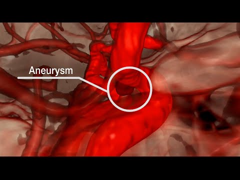 Mayo Clinic Minute – The difference in brain aneurysms [Video]