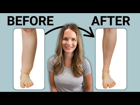 The Best Leg Lymphedema Treatment [Video]