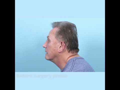 Deep-plane #FaceLift and #NeckLift Surgery — Before and After [Video]