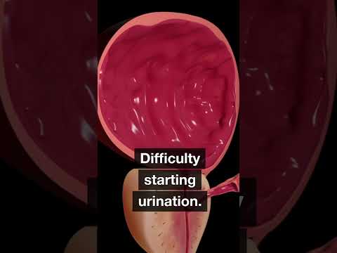 What Are the Symptoms of Prostate Cancer? [Video]
