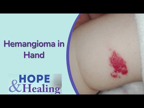 Hemangioma In The Hand | Treating Hand Pain Town Hall [Video]