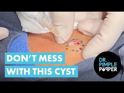 Don’t Mess With This Cyst [Video]