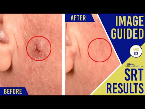 Image-Guided SRT Results Part 3 | Before & After | Haber Dermatology Cleveland 2 [Video]