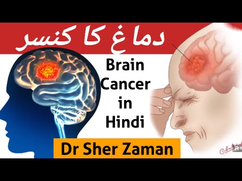 Brain Cancer: Symptoms, Causes, and Treatment Options [Video]
