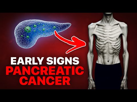 Early WARNING SIGNS of Pancreatic Cancer You Shouldn’t Ignore [Video]