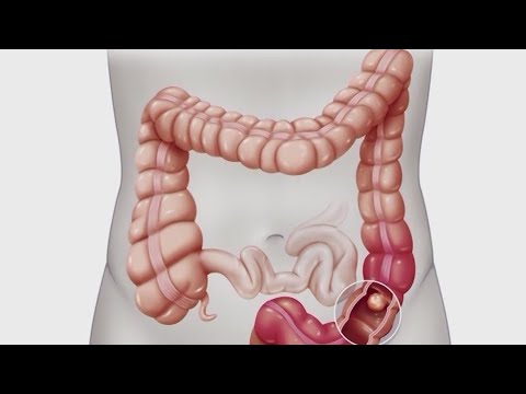 Colon cancer awareness: Doctors suggest colonoscopy [Video]