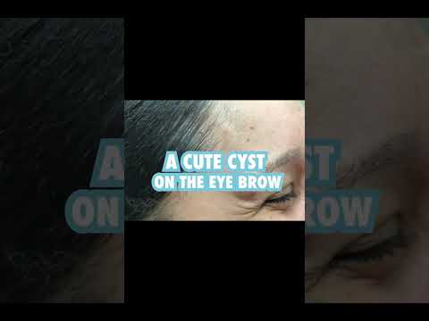 This was a cute cyst on the eyebrow 💁🏻‍♀️ [Video]