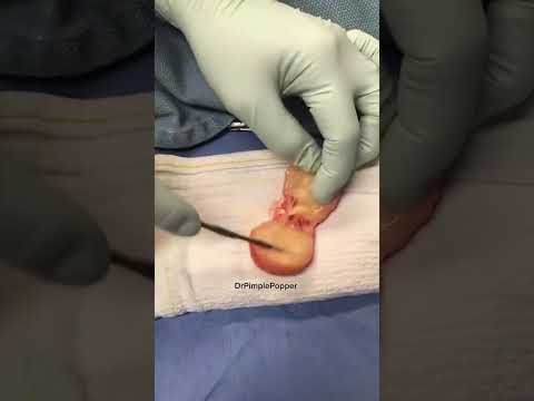 What’s Inside a Lipoma? [Video]