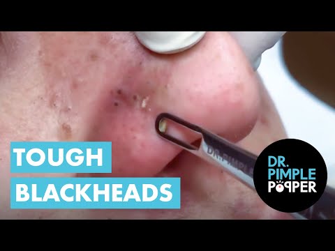 Dr Pimple Popper vs Tough Blackheads [Video]