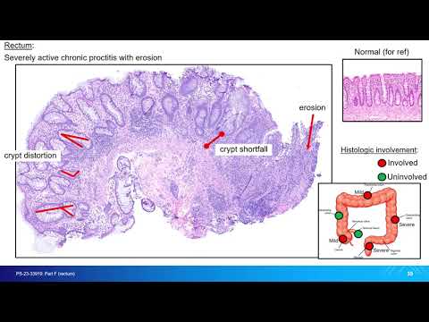 Session 3_ Progression of Left Sided Colitis [Video]