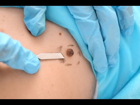Melanoma and the Wrong Site [Video]