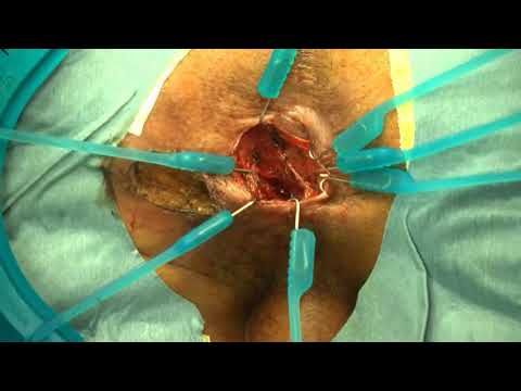 Technical notes Subtotal fistulectomy and sliding anoderm flap: A new sphincter-sparing technique [Video]