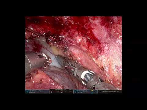 Robotic removal of a presacral cyst [Video]