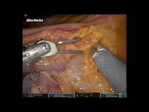 Technical Pearls in D3 Lymph Node Dissection for right-sided colon cancer [Video]
