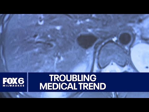 Colorectal cancer rising in young people | FOX6 News Milwaukee [Video]