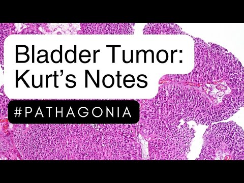 Bladder Tumors: Kurt’s Notes [Video]