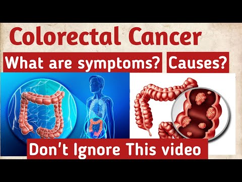 what is colorectal cancer-  what causes colon cancer, rectal cancer symptoms, colon cancer treatment [Video]