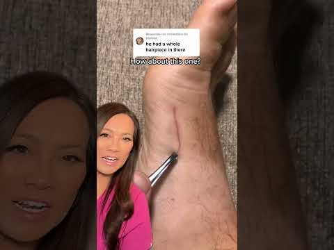 Dr Pimple Popper Reacts to Inflamed Ingrown that Looks SATISFYING to Pull Out [Video]