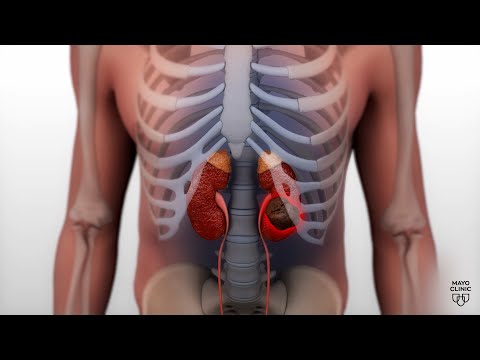 Mayo Clinic Minute: Advances in treating kidney cancer [Video]