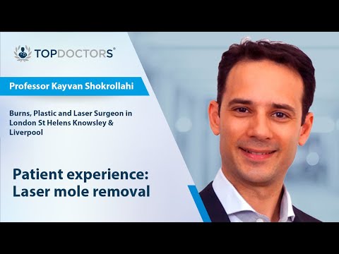 Patient experience: Laser mole removal [Video]