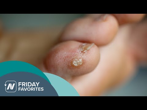 Friday Favorites: Removing Warts with Duct Tape [Video]